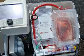 Як «серце в коробці» допомагає рятувати пацієнтів, які потребують трансплантації