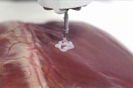 3D-принтер, який друкує прямо всередині тіла людини, допоможе видаляти ракові пухлини